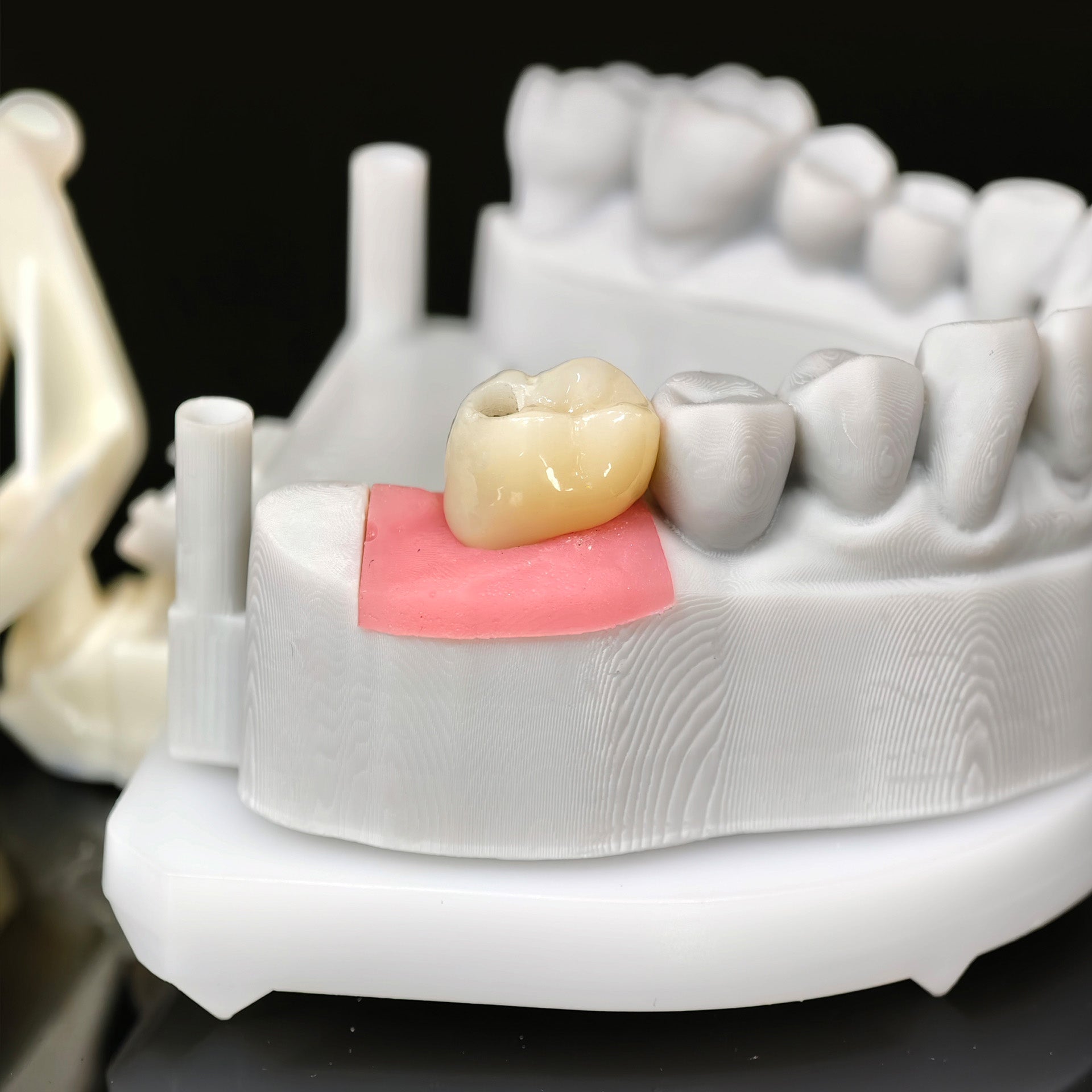 Zirconia Crown With Screw Retained