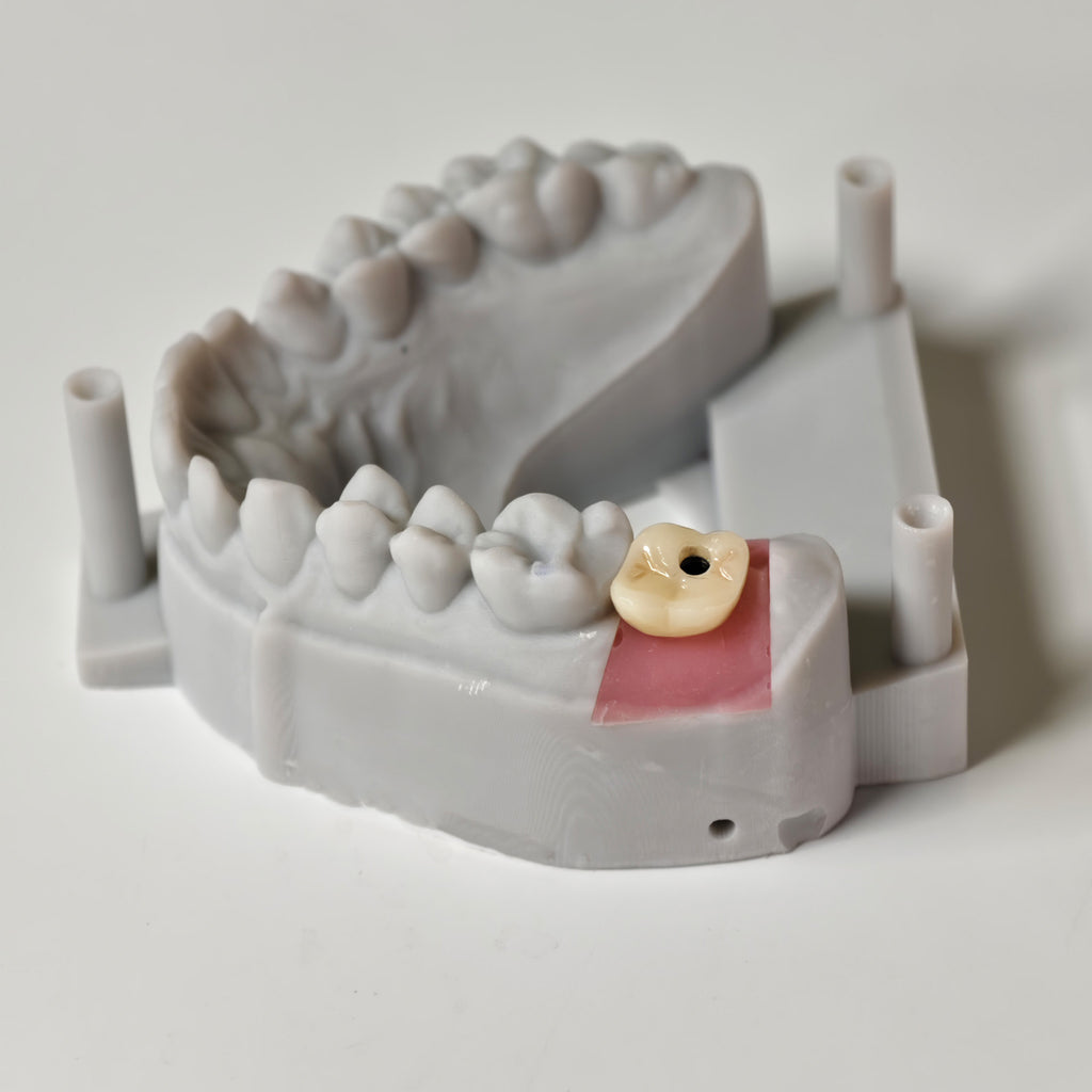 Zirconia Crown With Screw Retained