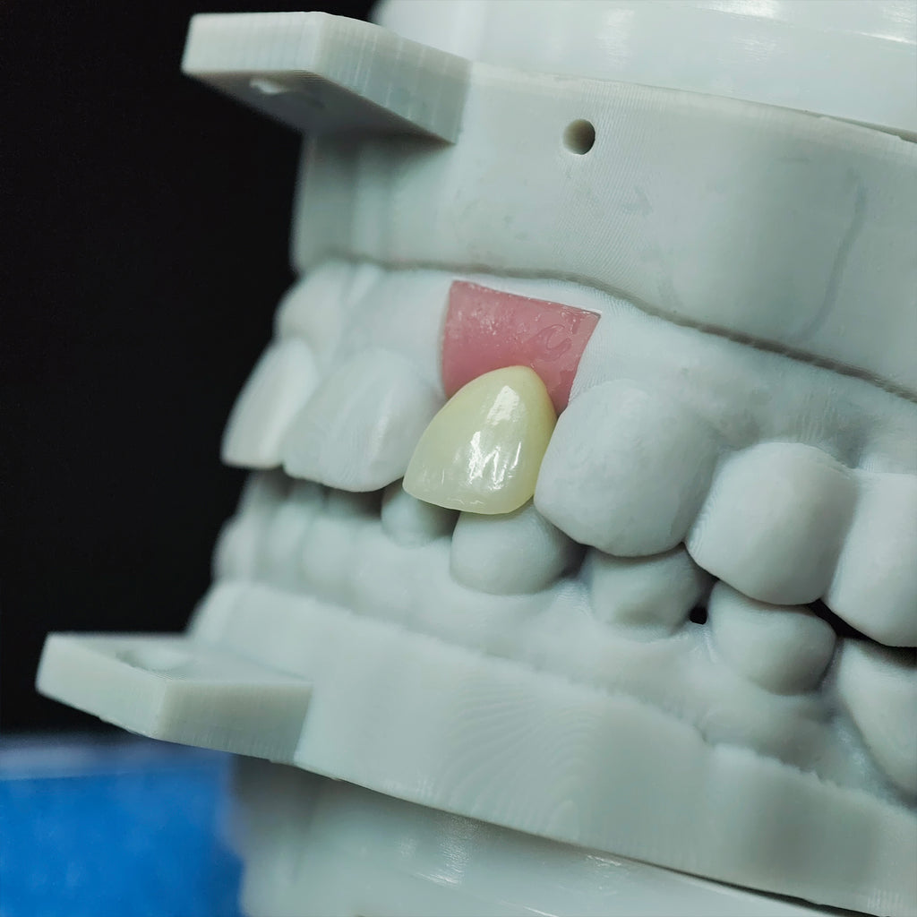 Zirconia Crown With Screw Retained