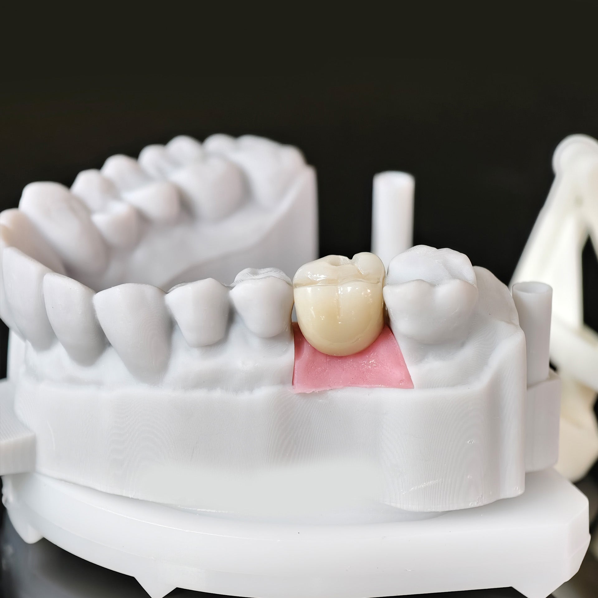 Zirconia Crown With Screw Retained