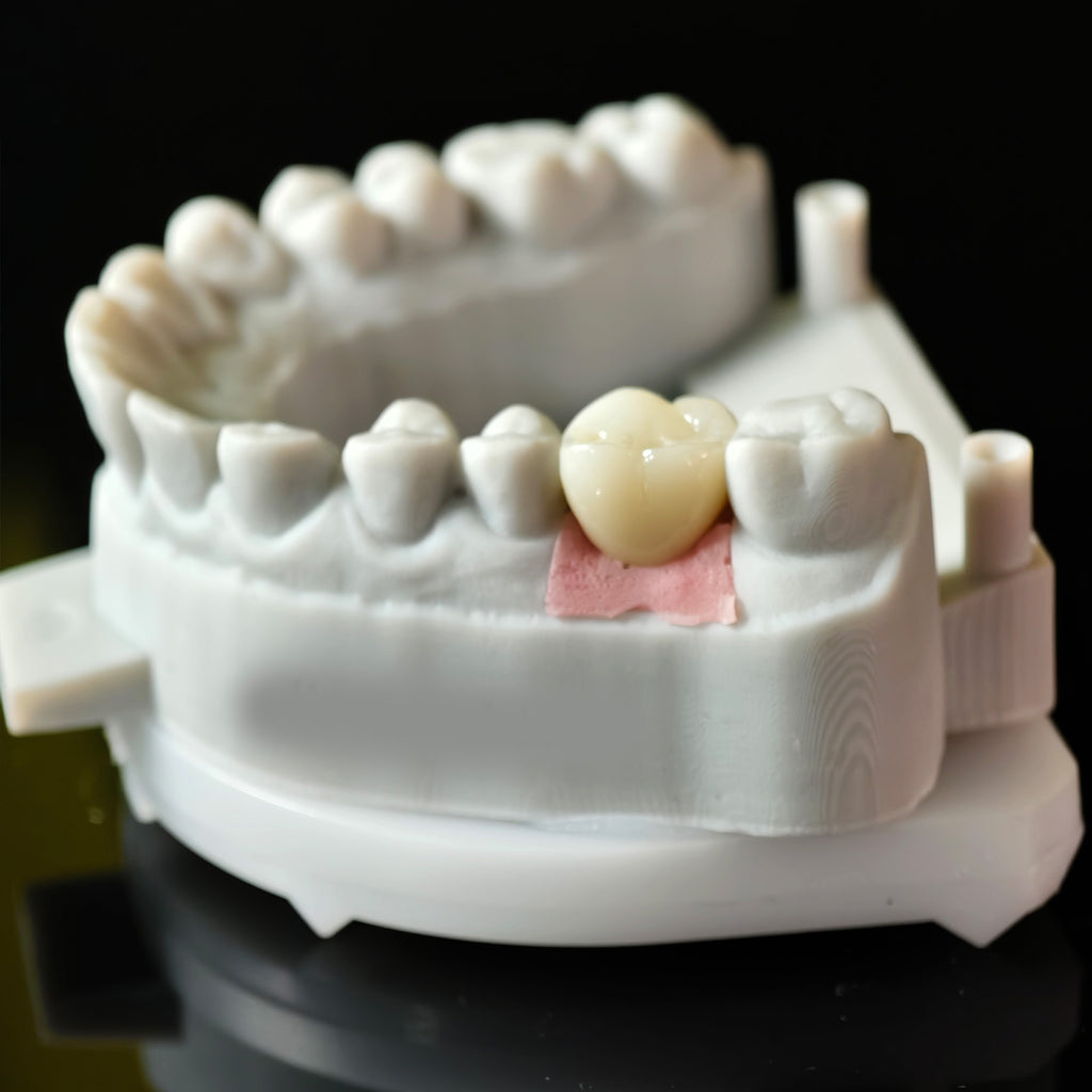 Zirconia Crown With Screw Retained