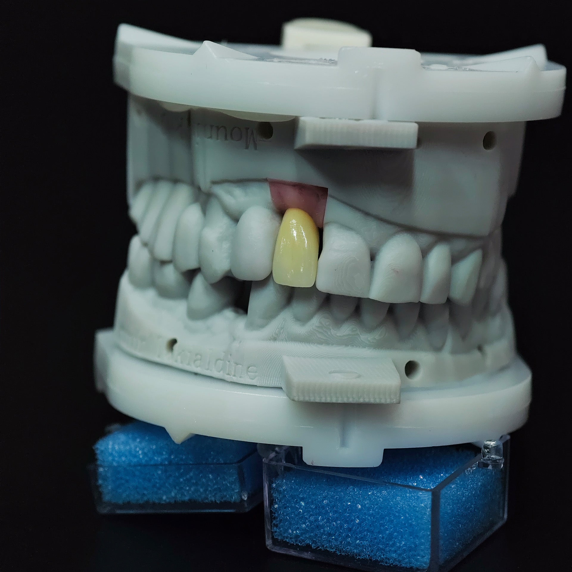 Zirconia Crown With Screw Retained