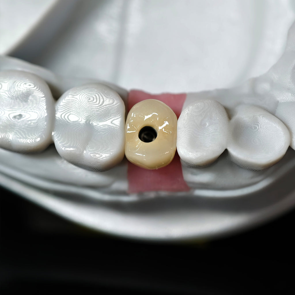 Zirconia Crown With Screw Retained