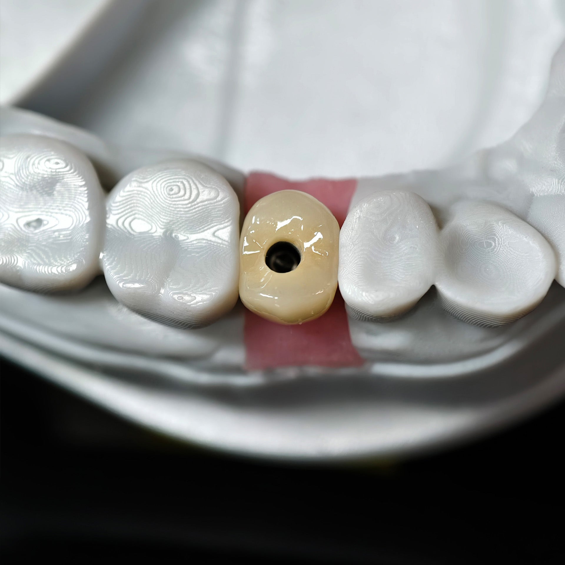 Zirconia Crown With Screw Retained