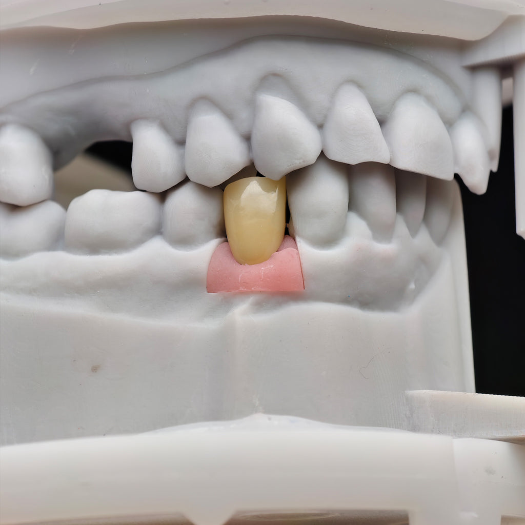 Zirconia Crown With Screw Retained