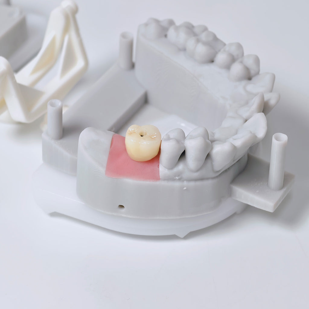 Zirconia Crown With Screw Retained