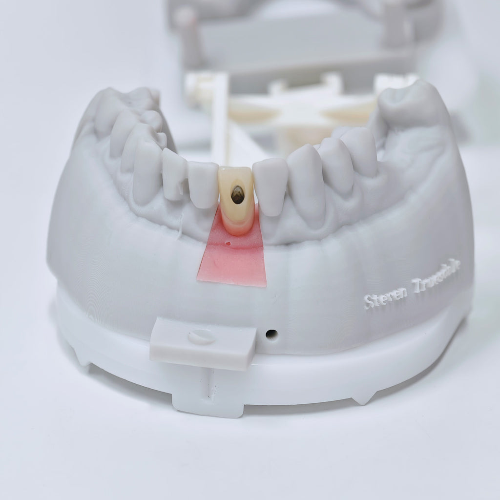 Zirconia Crown With Screw Retained