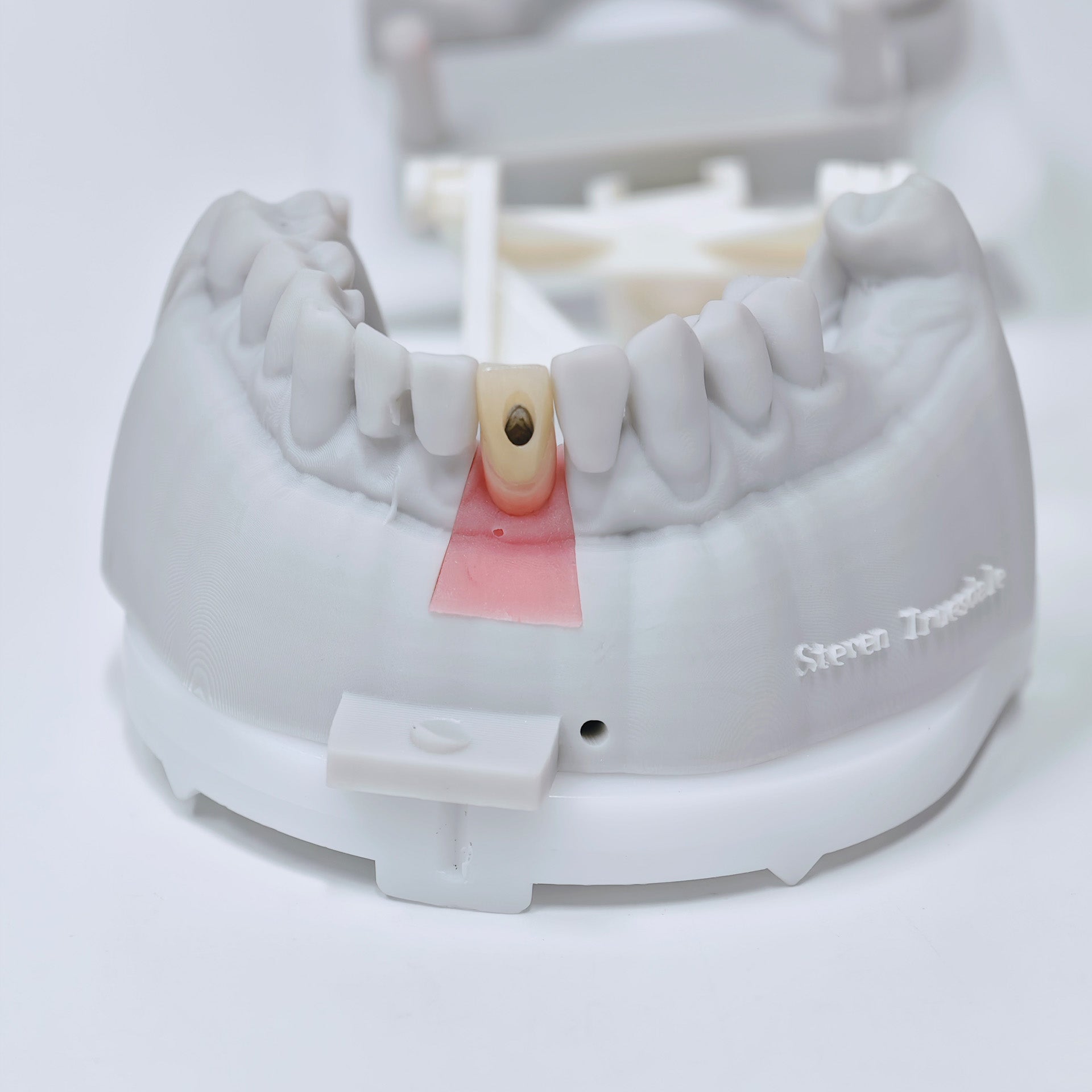 Zirconia Crown With Screw Retained