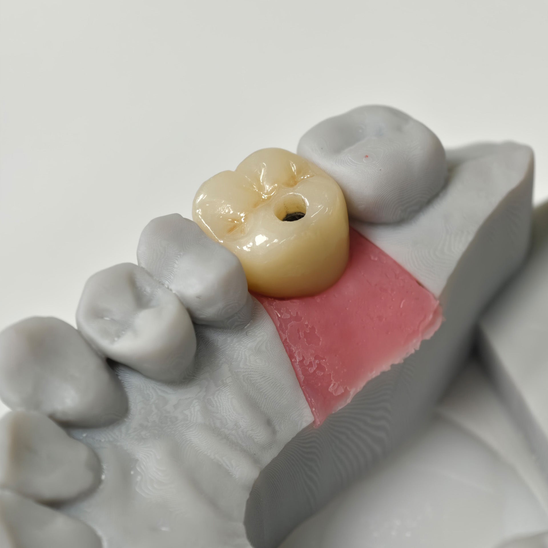 Zirconia Crown With Screw Retained