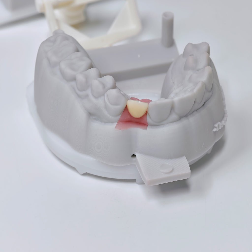 Zirconia Crown With Screw Retained