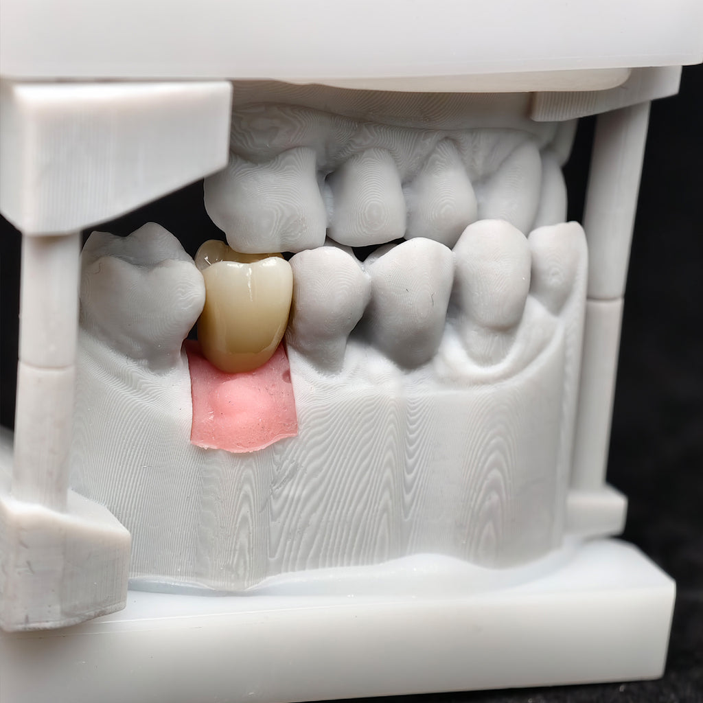 Zirconia Crown With Screw Retained