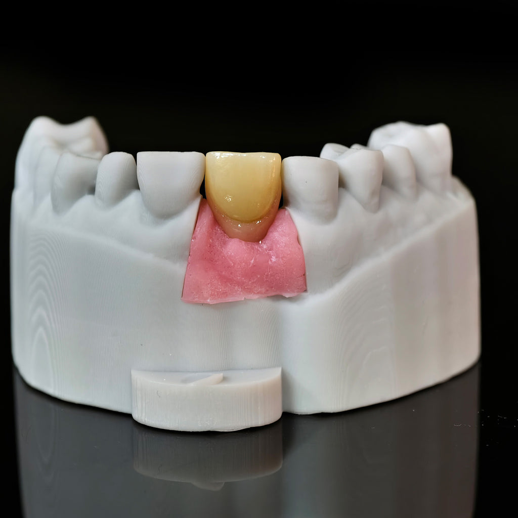 Zirconia Crown With Screw Retained