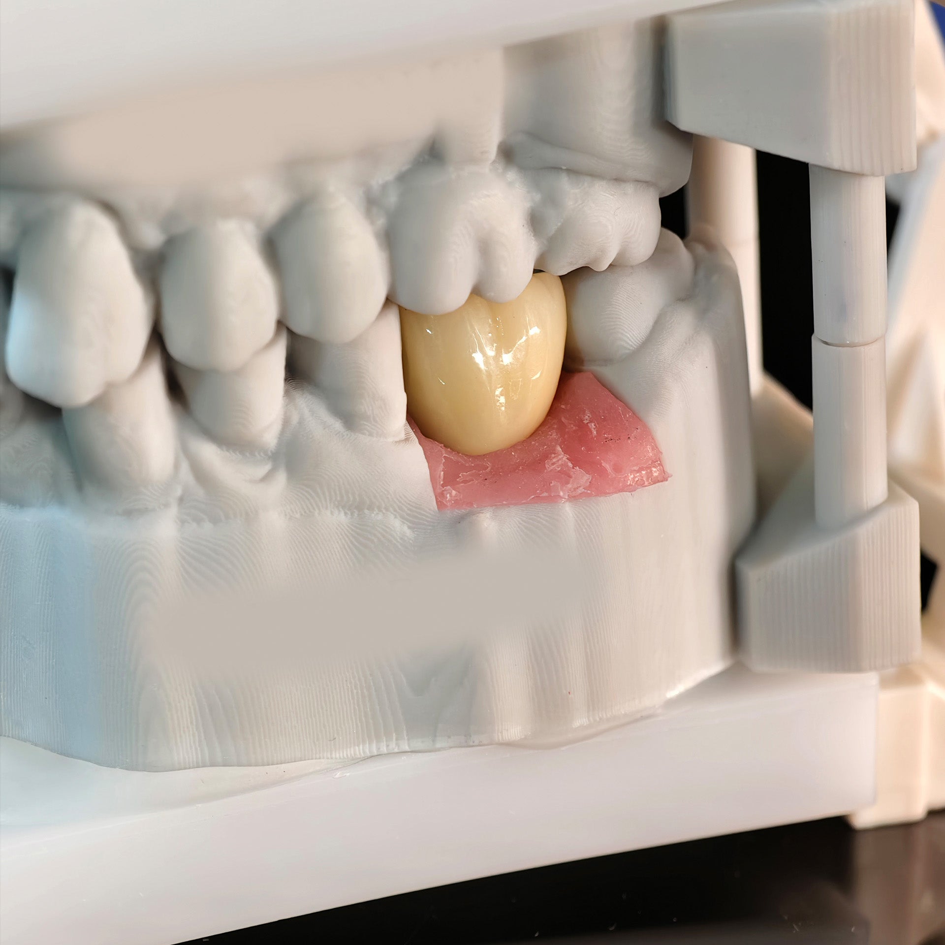 Zirconia Crown With Screw Retained