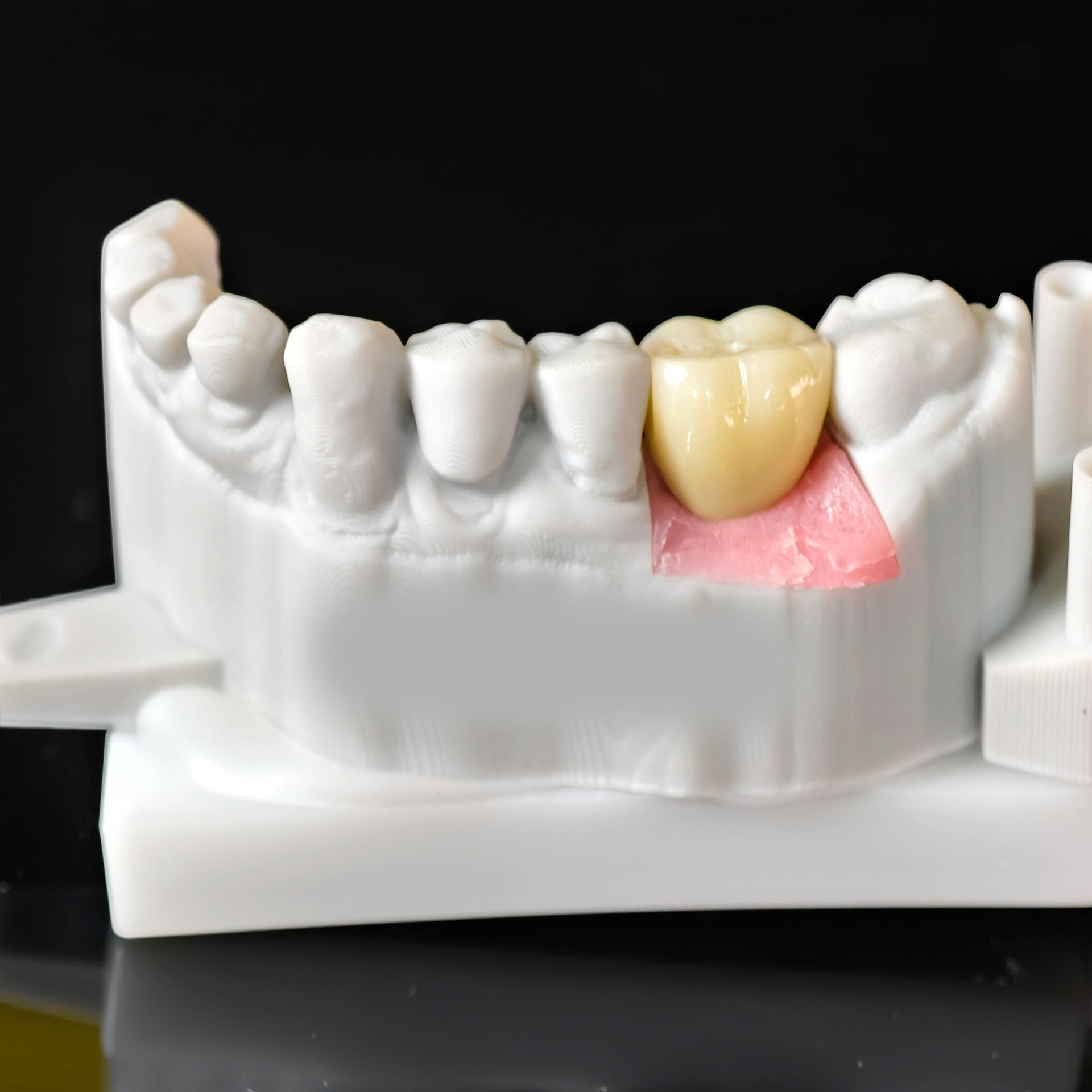 Zirconia Crown With Screw Retained
