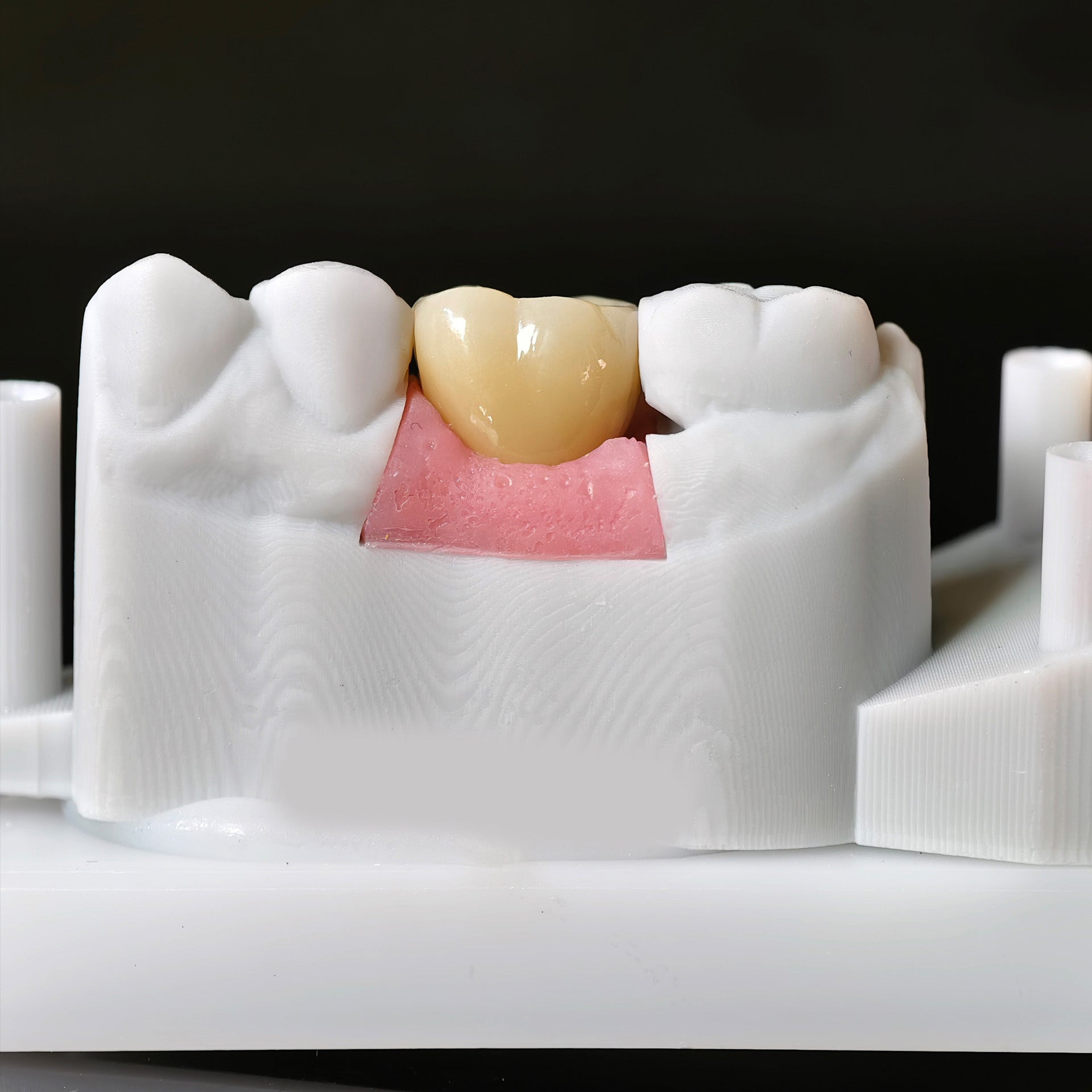 Zirconia Crown With Screw Retained