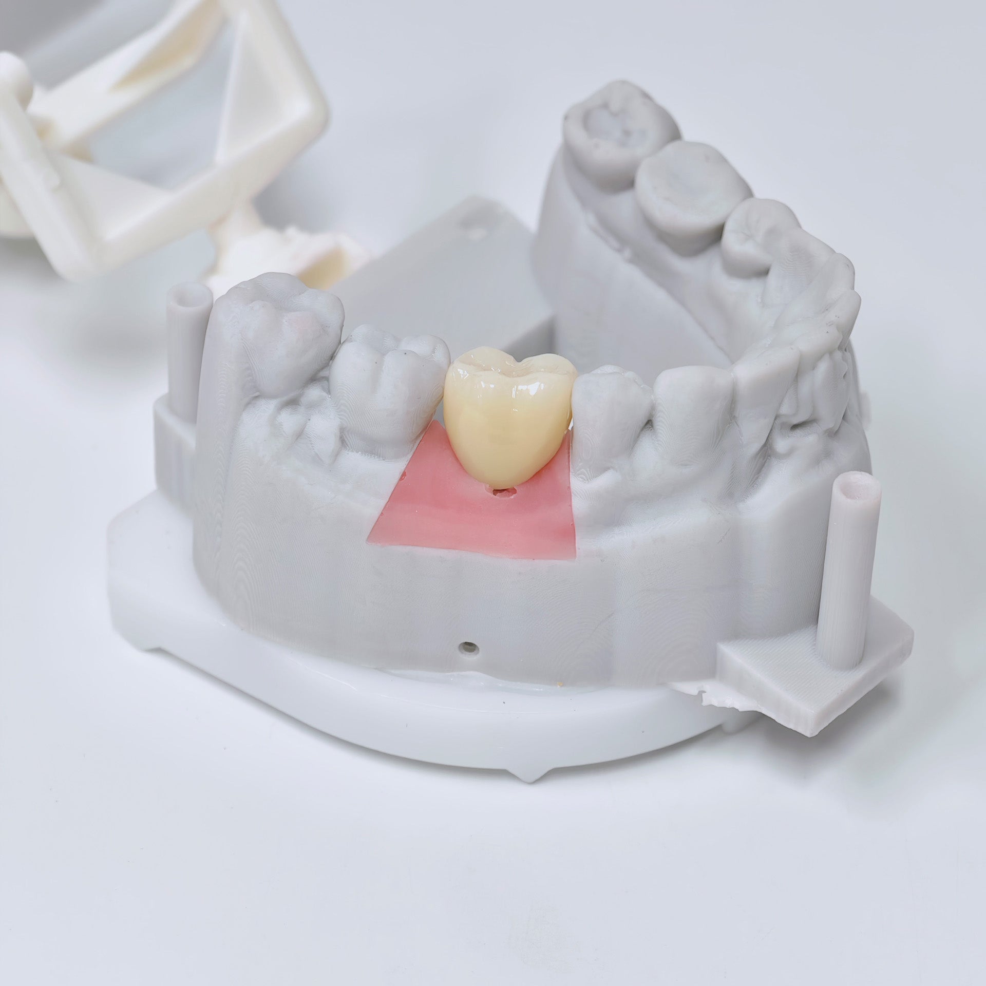 Zirconia Crown With Screw Retained