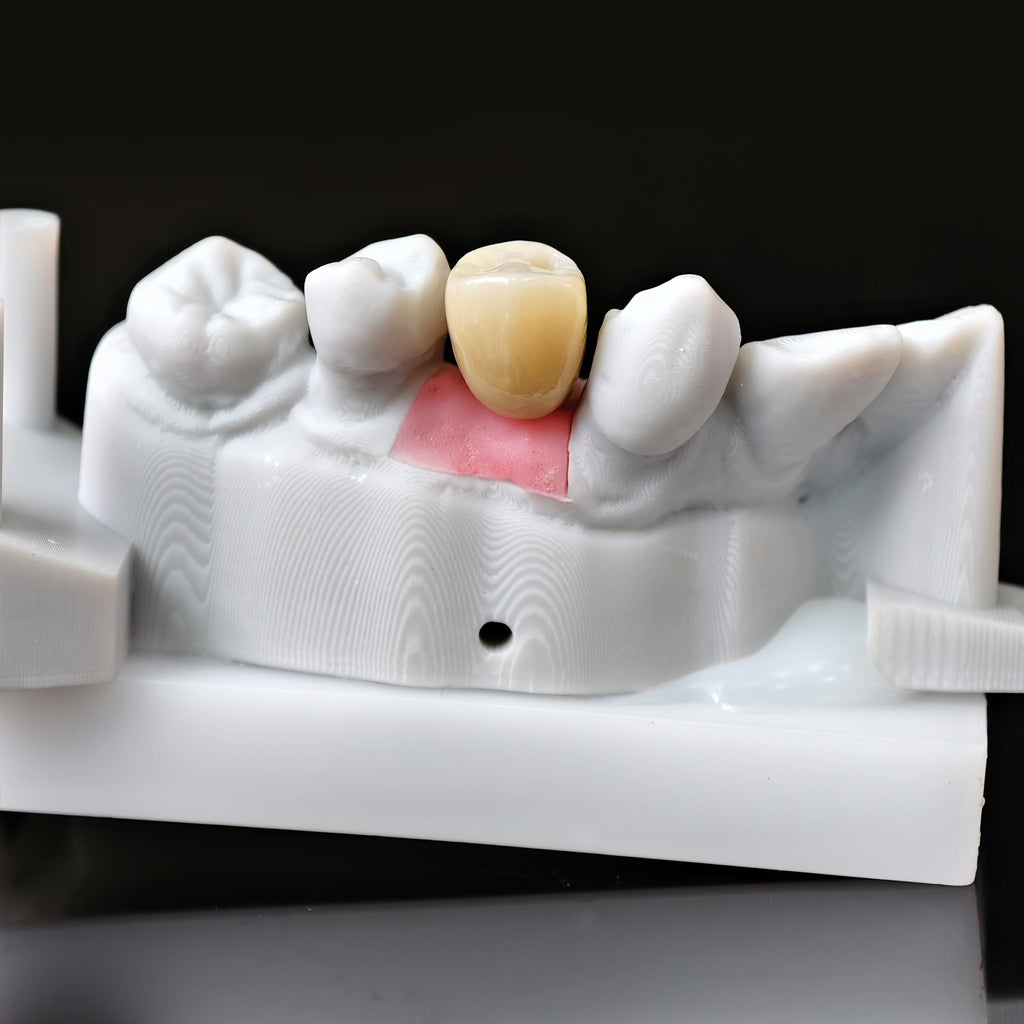 Zirconia Crown With Screw Retained