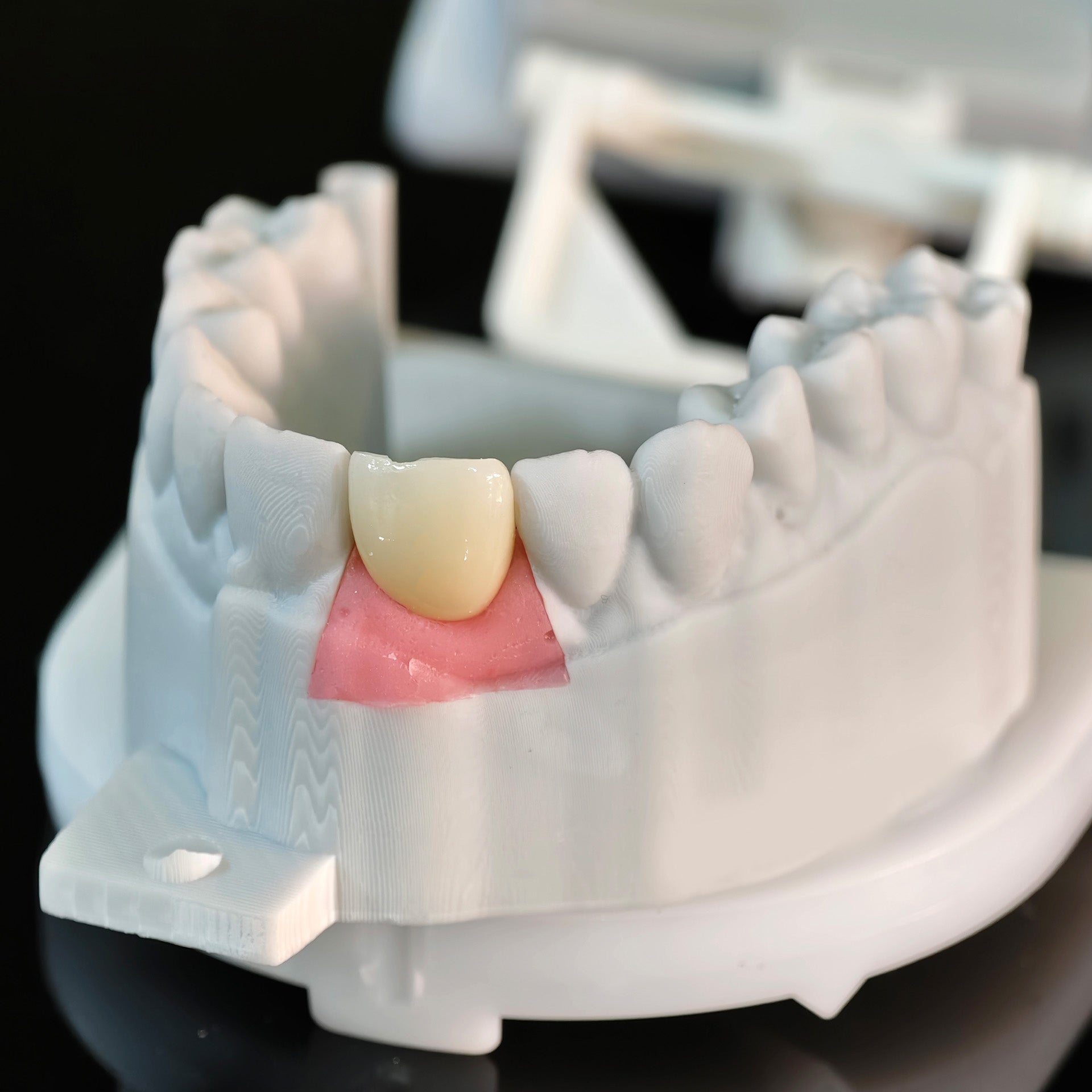 Zirconia Crown With Screw Retained