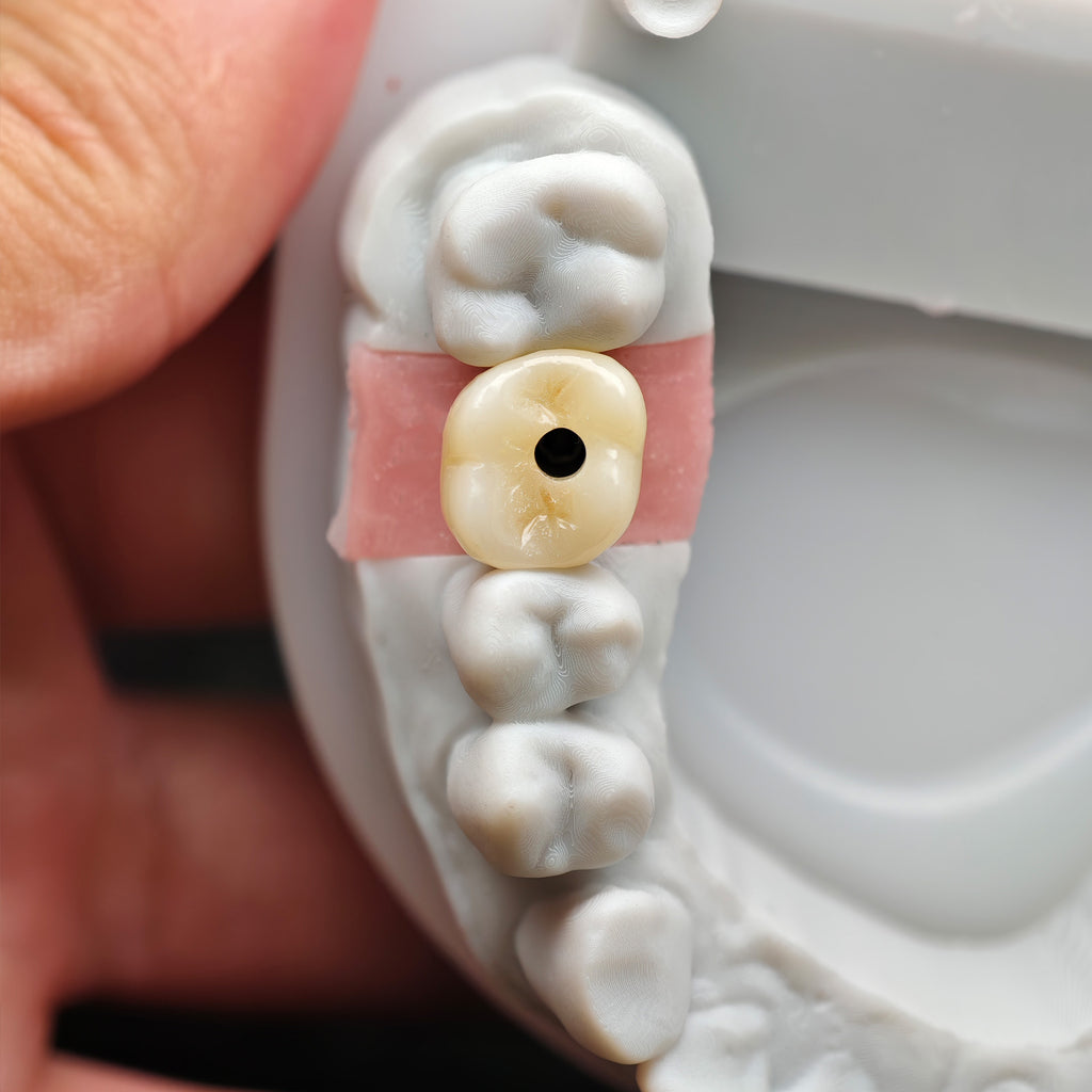 Zirconia Crown With Screw Retained