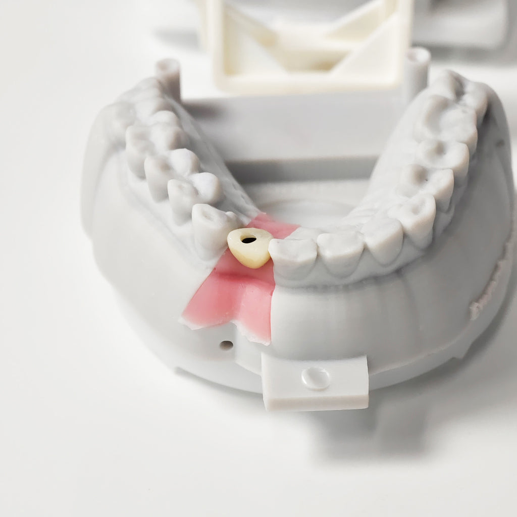 Zirconia Crown With Screw Retained