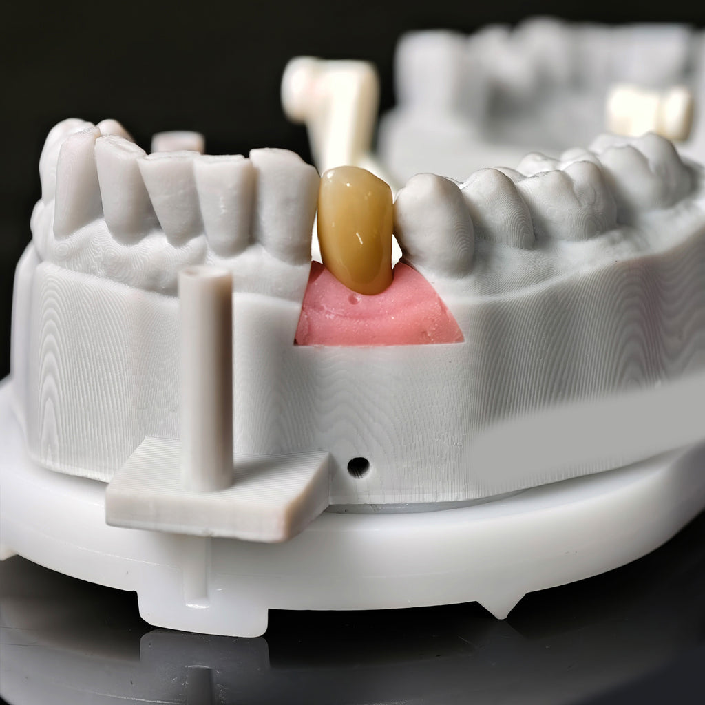 Zirconia Crown With Screw Retained