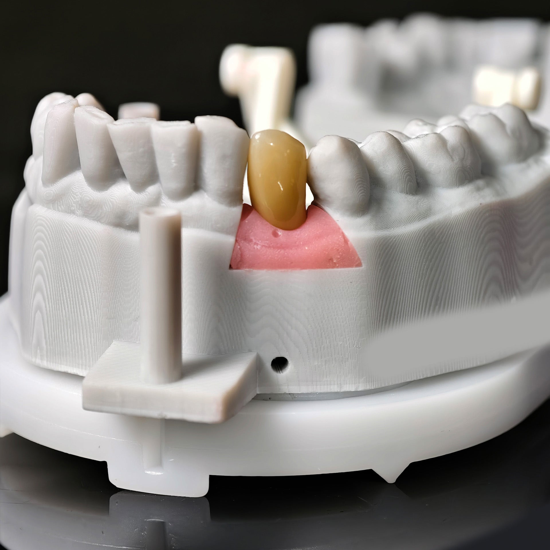 Zirconia Crown With Screw Retained