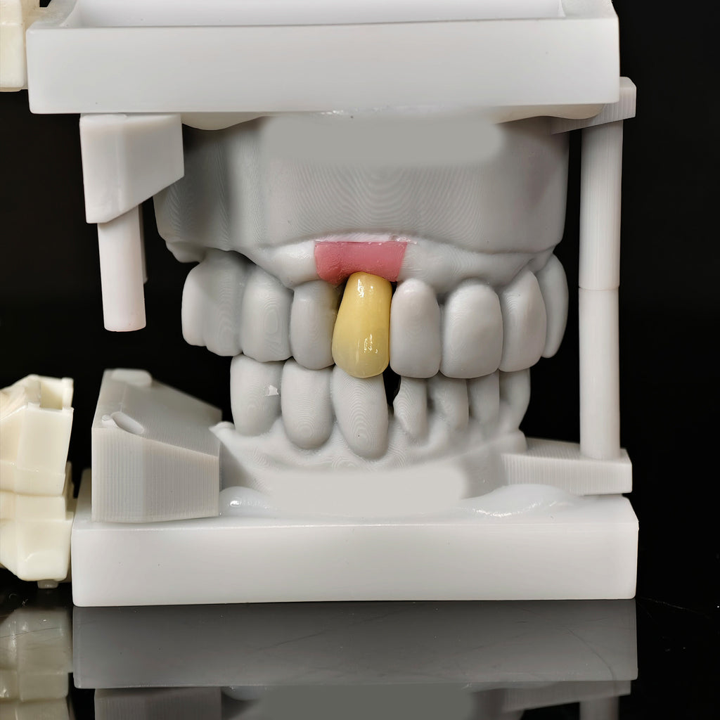 Zirconia Crown With Screw Retained