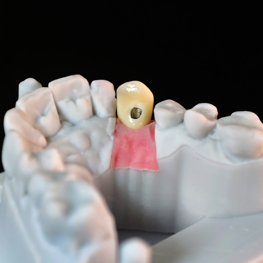 Zirconia Crown With Screw Retained