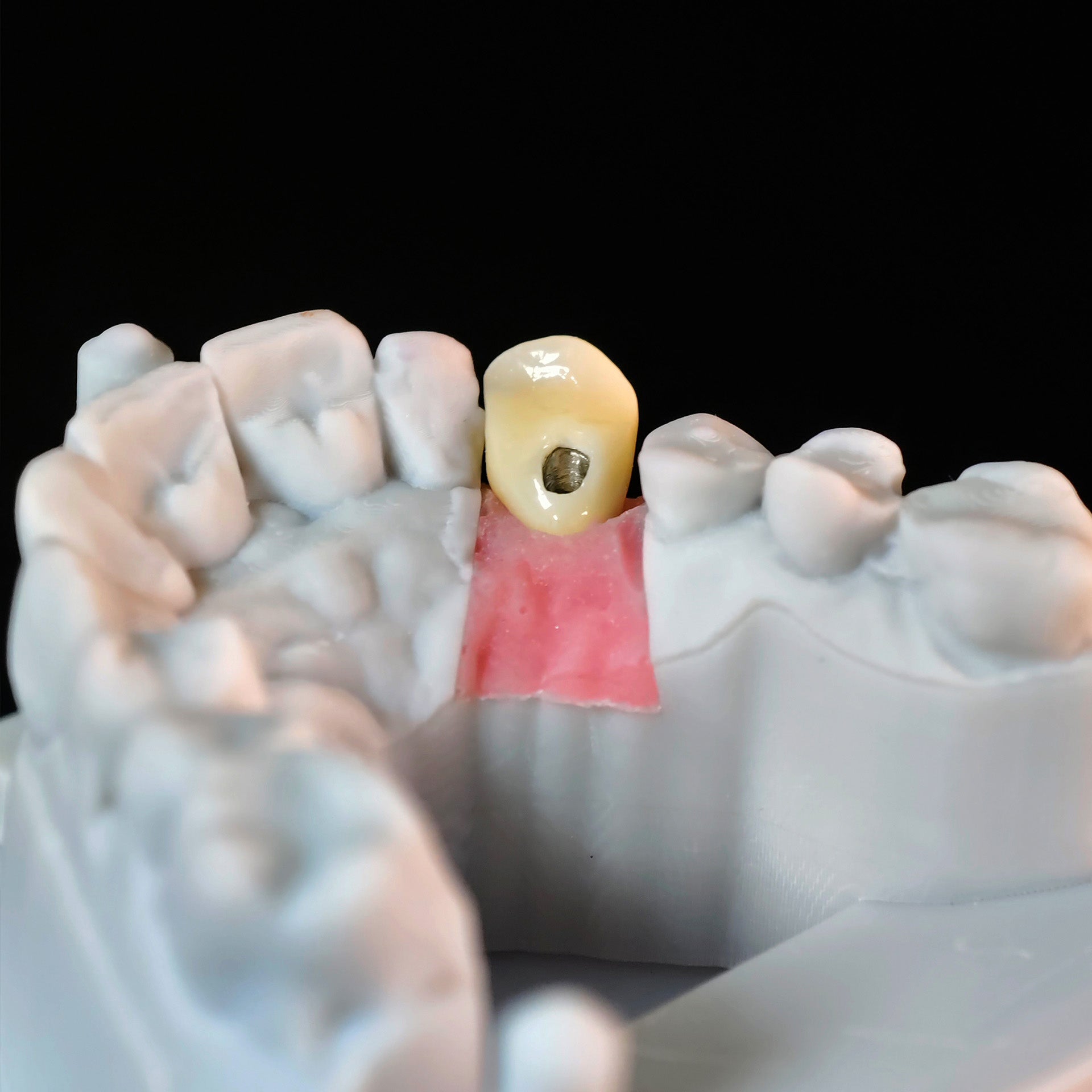 Zirconia Crown With Screw Retained