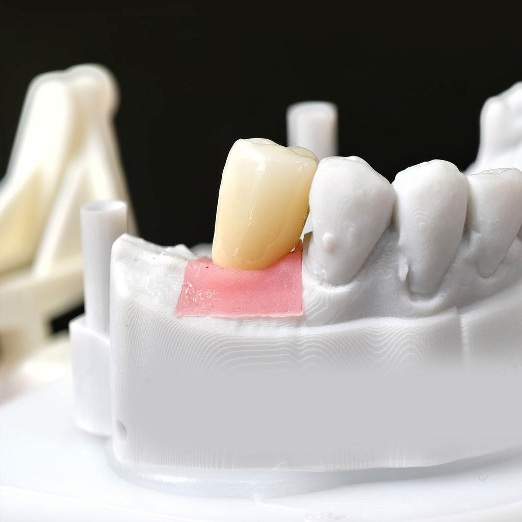 Zirconia Crown With Screw Retained