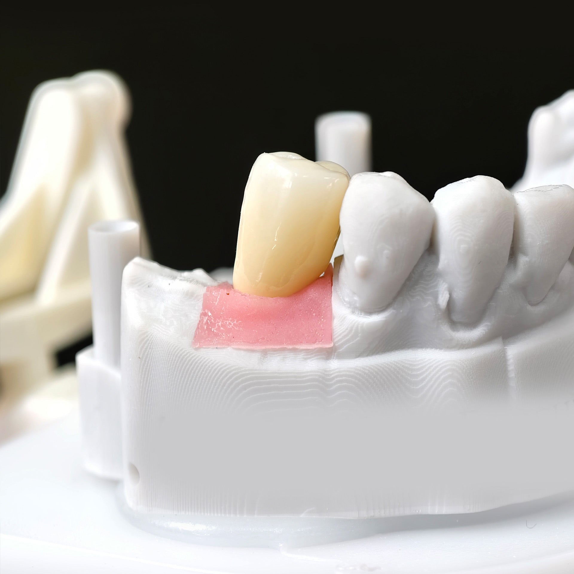 Zirconia Crown With Screw Retained