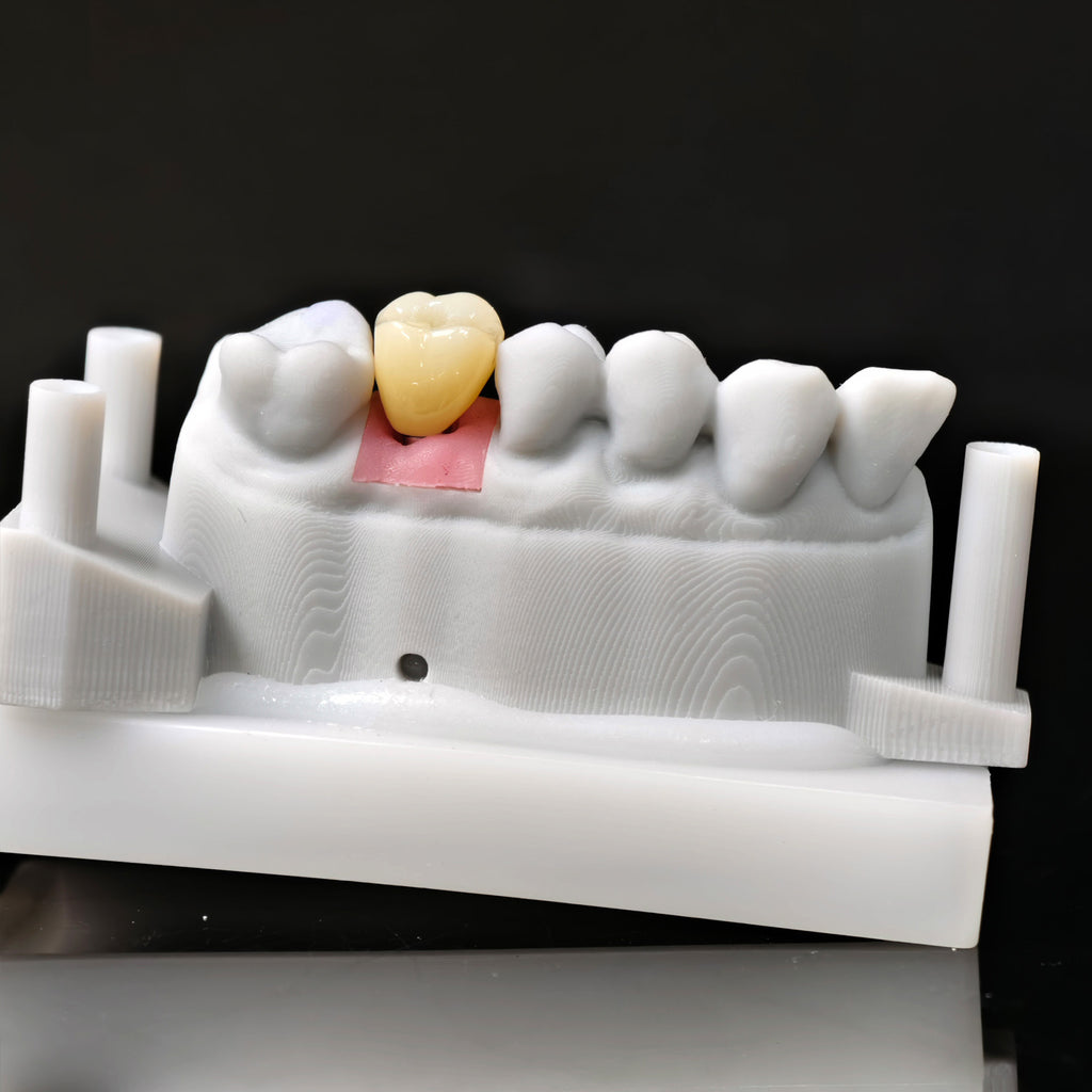 Zirconia Crown With Screw Retained