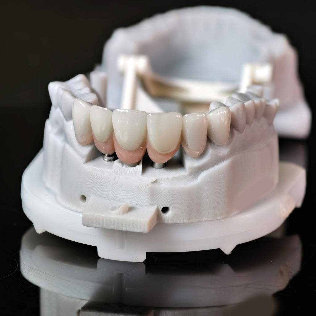 Zirconia Crown With Screw Retained And Cement Retained And Ceramic Veneers