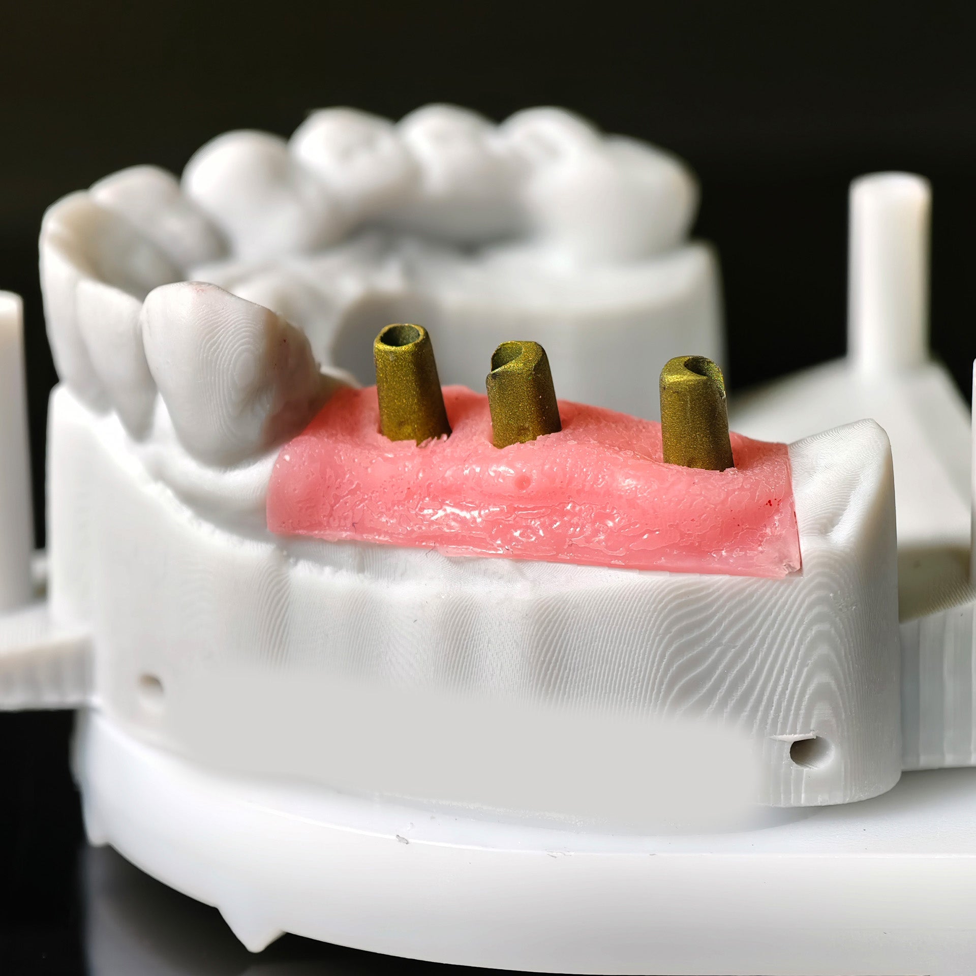 Zirconia Implant Bridge Screwmentable Dental Crown