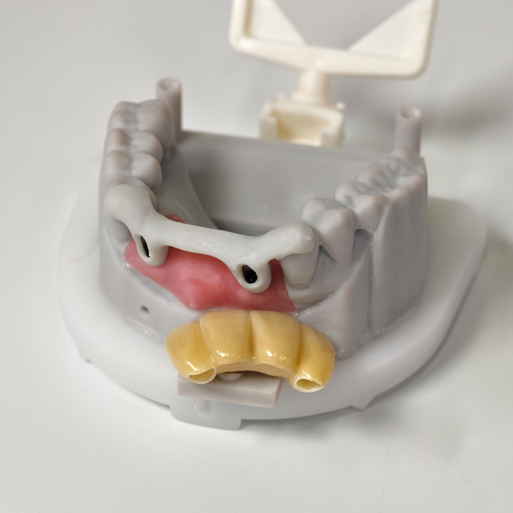 Zirconia Implant Bridge Screwmentable Dental Crown