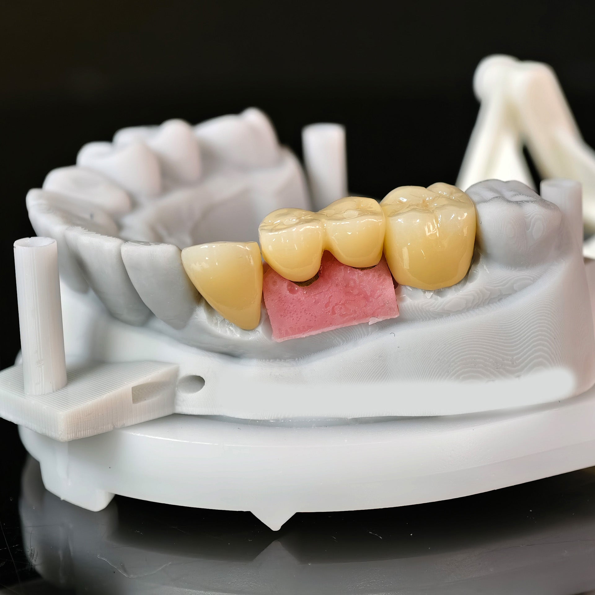 Zirconia Implant Bridge Screwmentable Dental Crown