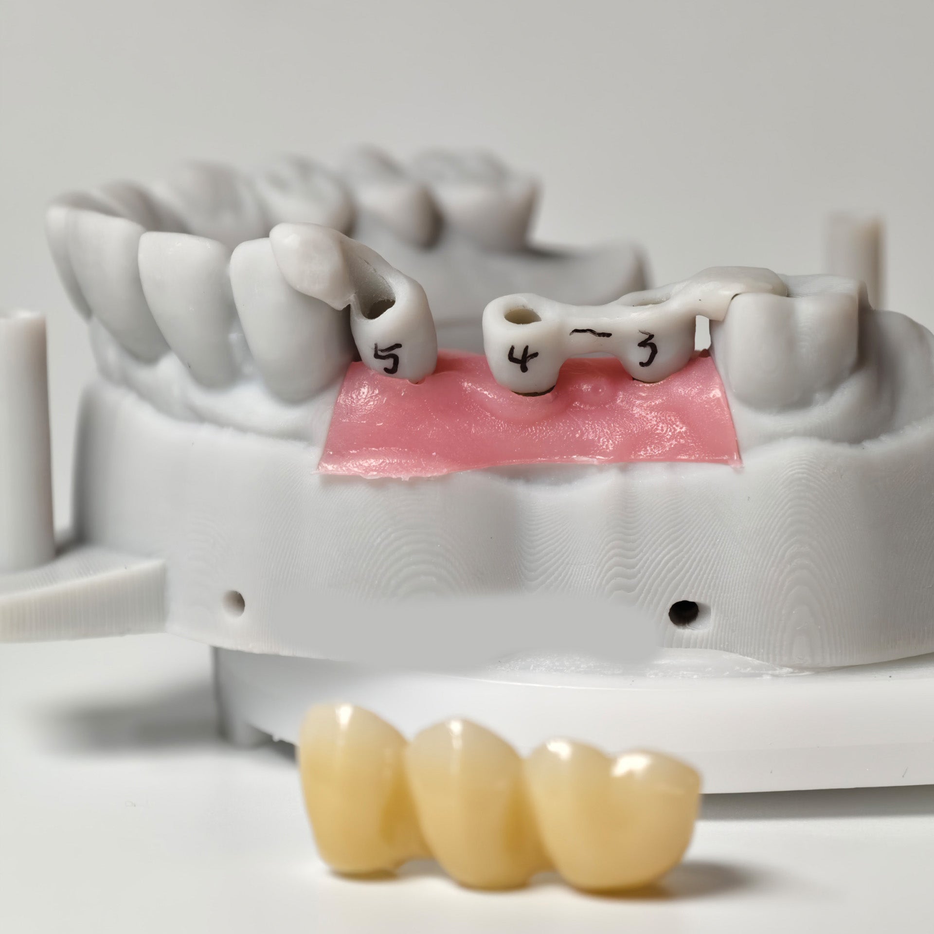 Zirconia Implant Bridge Screwmentable Dental Crown