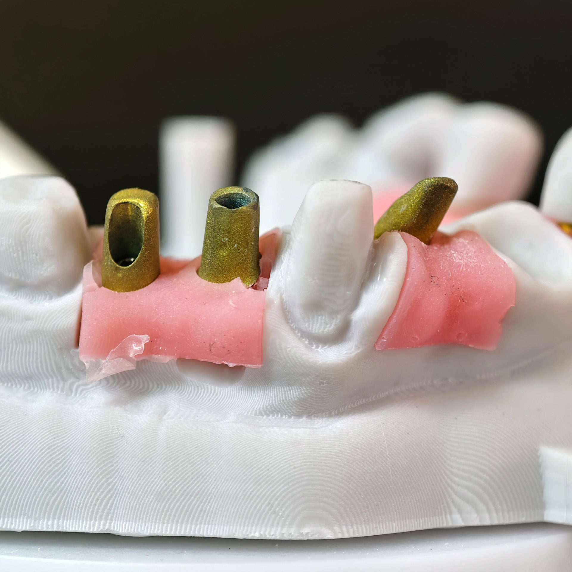 Zirconia Implant Bridge Screwmentable Dental Crown
