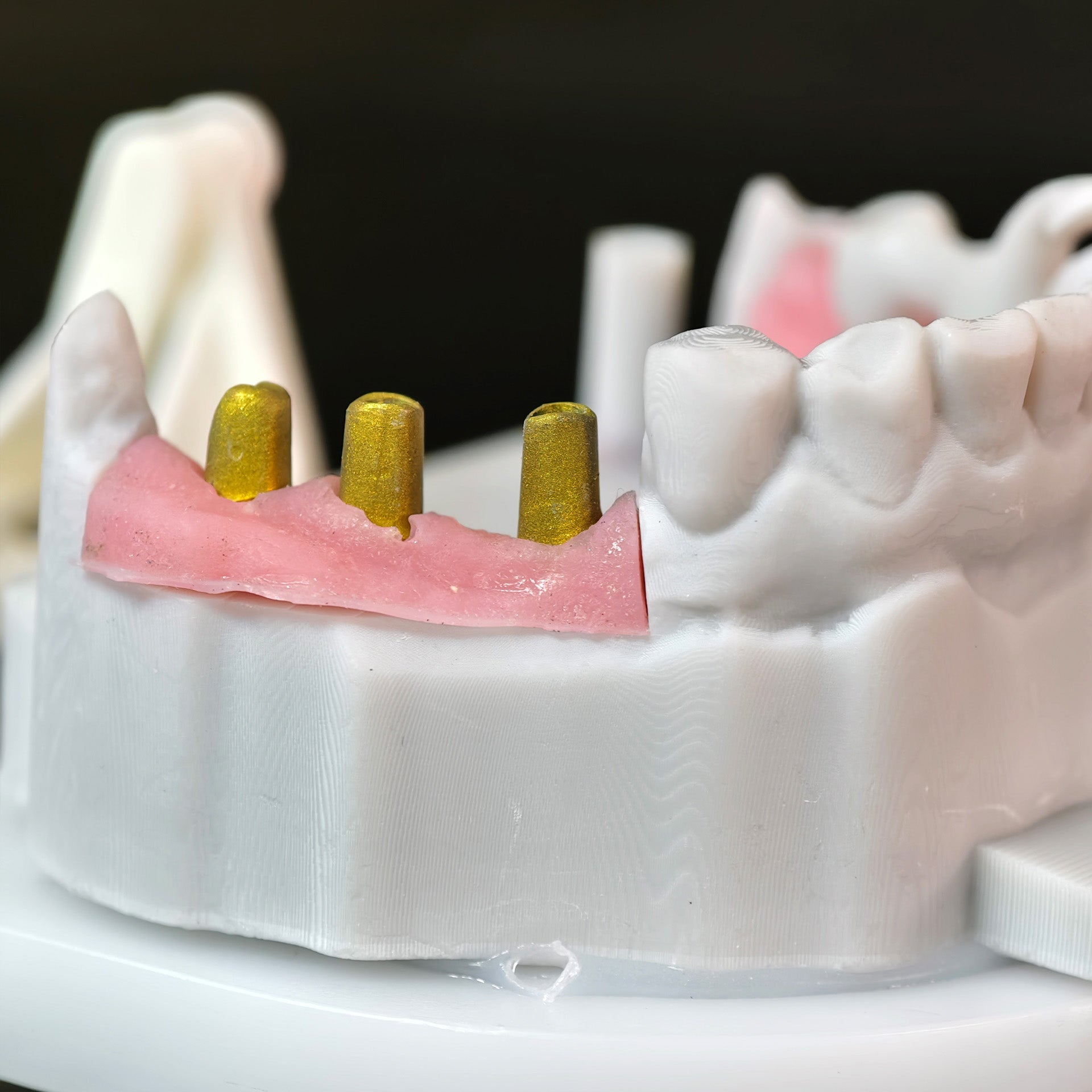 Zirconia Implant Bridge Screwmentable Dental Crown