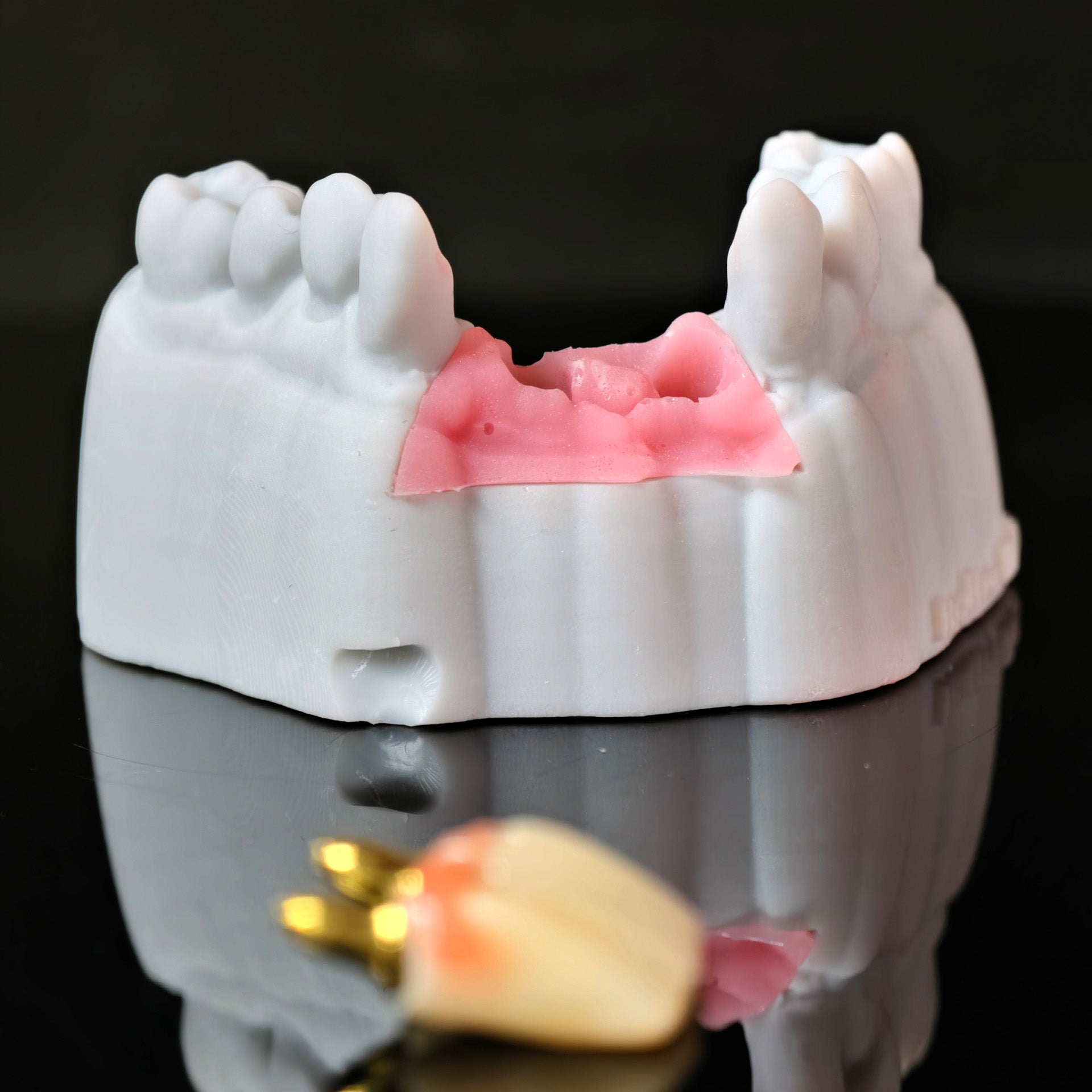 Zirconia Implant Bridge With Gold Plating