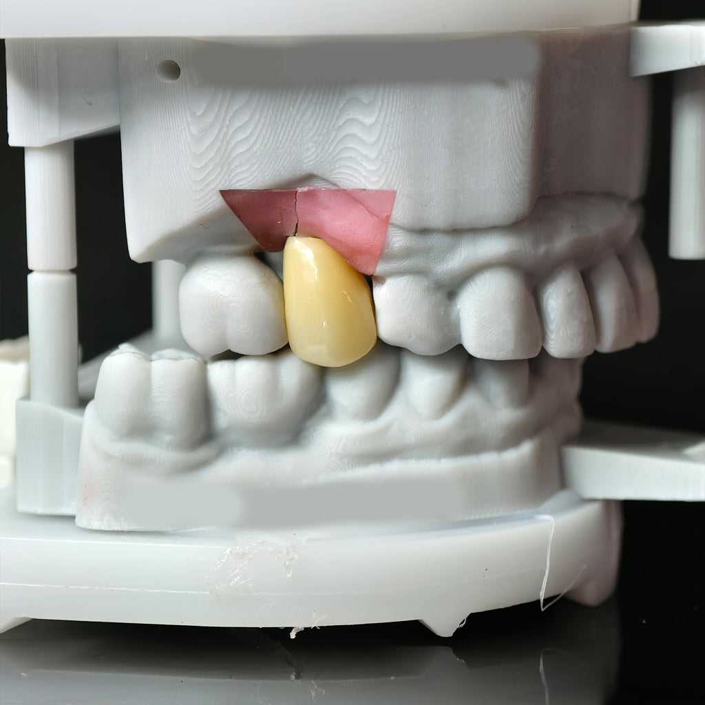 Zirconia Implant Crown Screwmentable Dental Crown