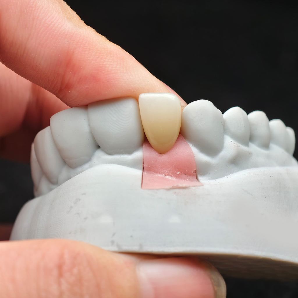 Zirconia Implant Crown Screwmentable Dental Crown