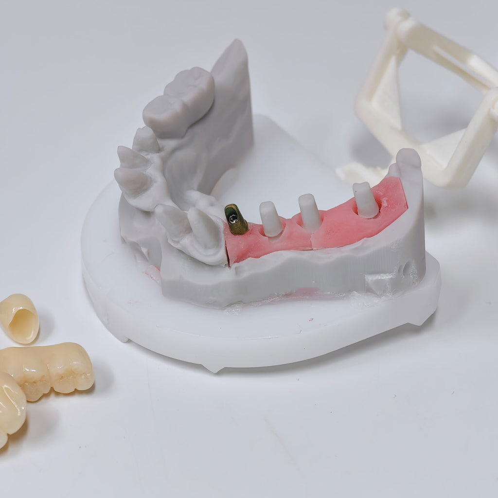 Zirconia Implant Crown And Bridges Screwmentable Dental Crown