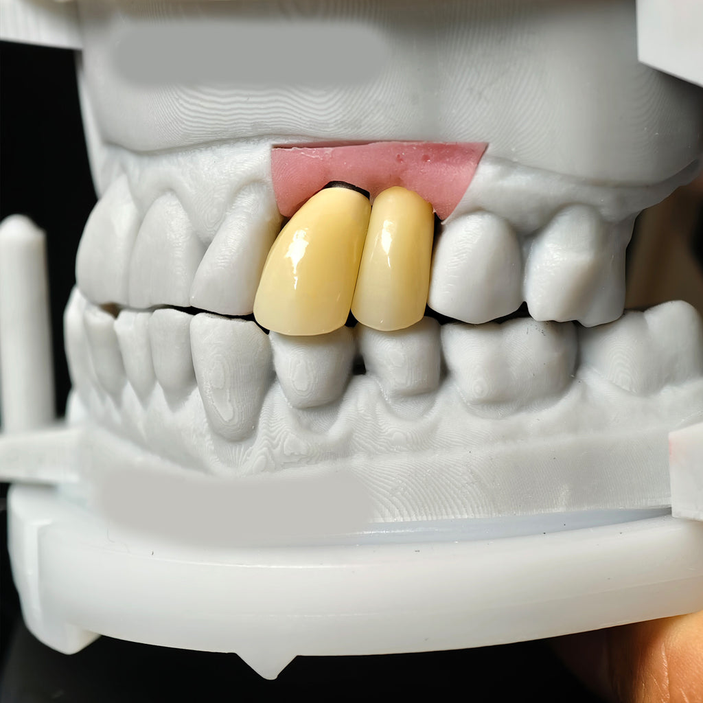 Zirconia Implant Crowns Screwmentable Dental Crown With Gold Plating