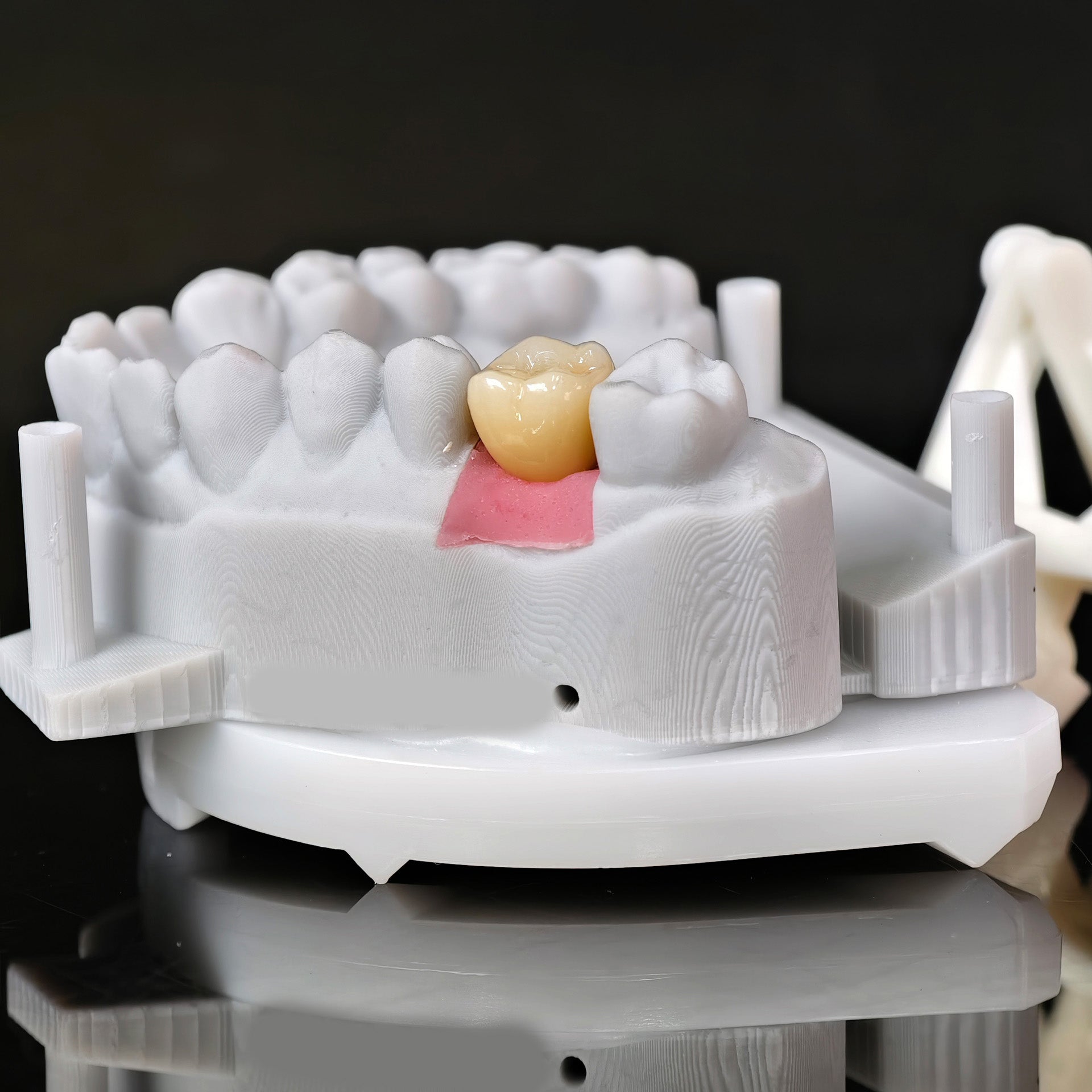 Zirconia Implant Crown With Gold Plating