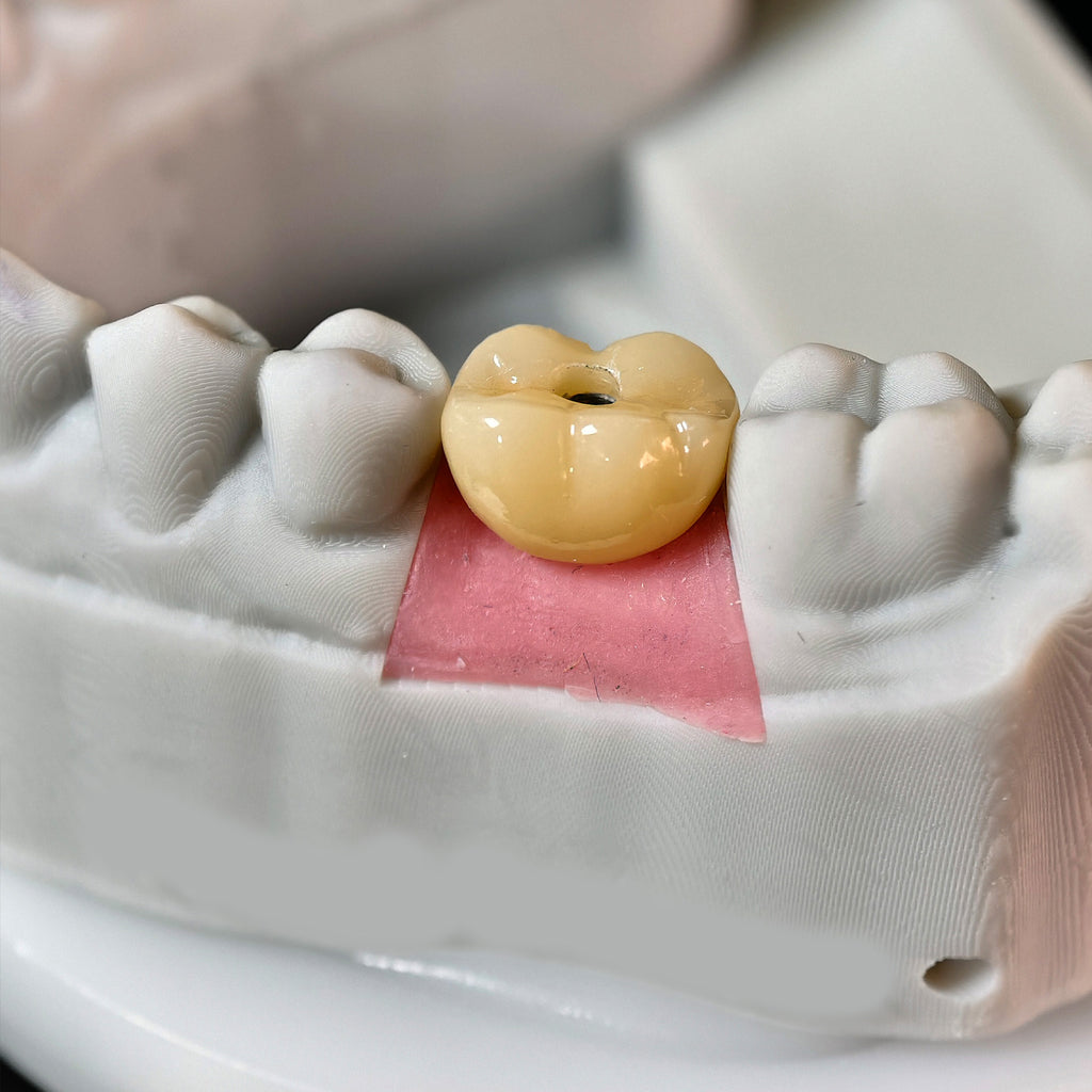 Zirconia Implant Crown With Gold Plating