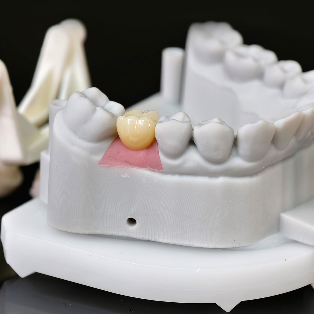 Zirconia Implant Crown With Gold Plating