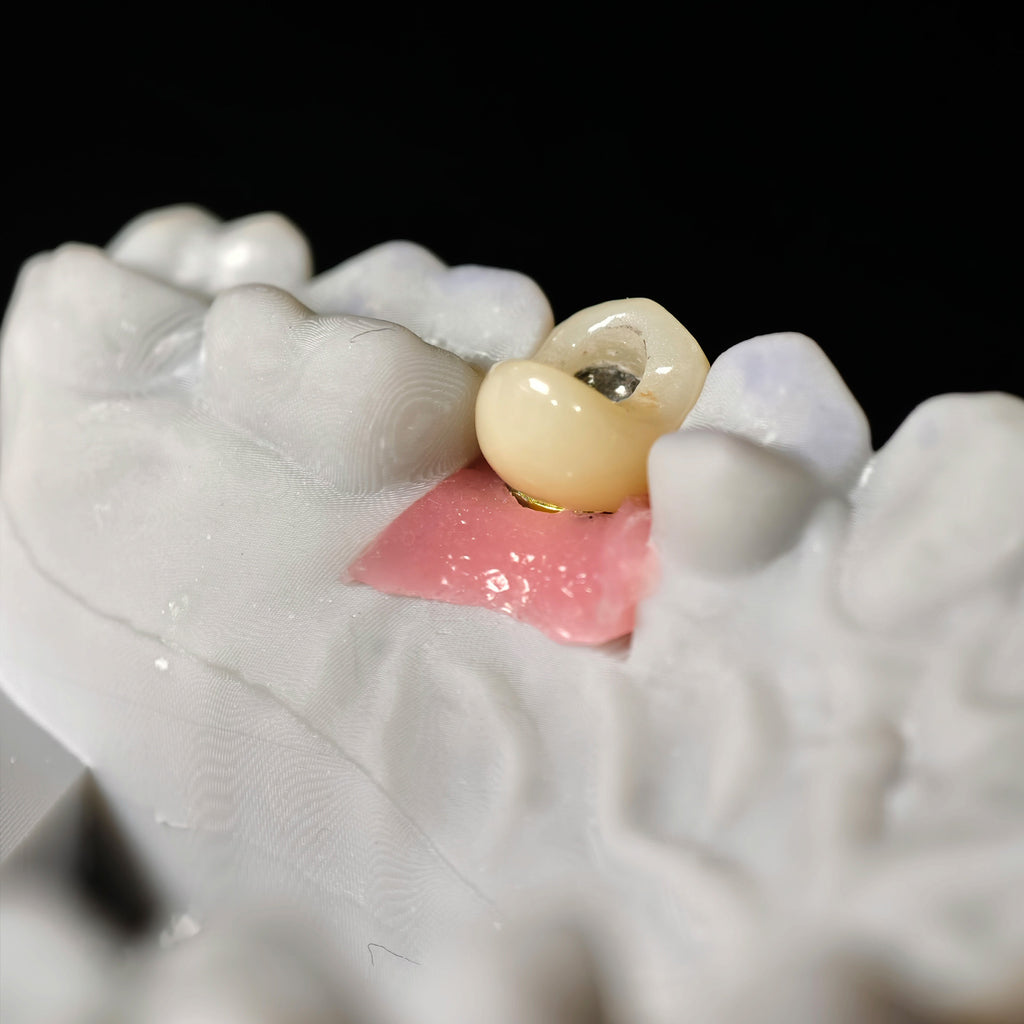 Zirconia Implant Crown With Gold Plating