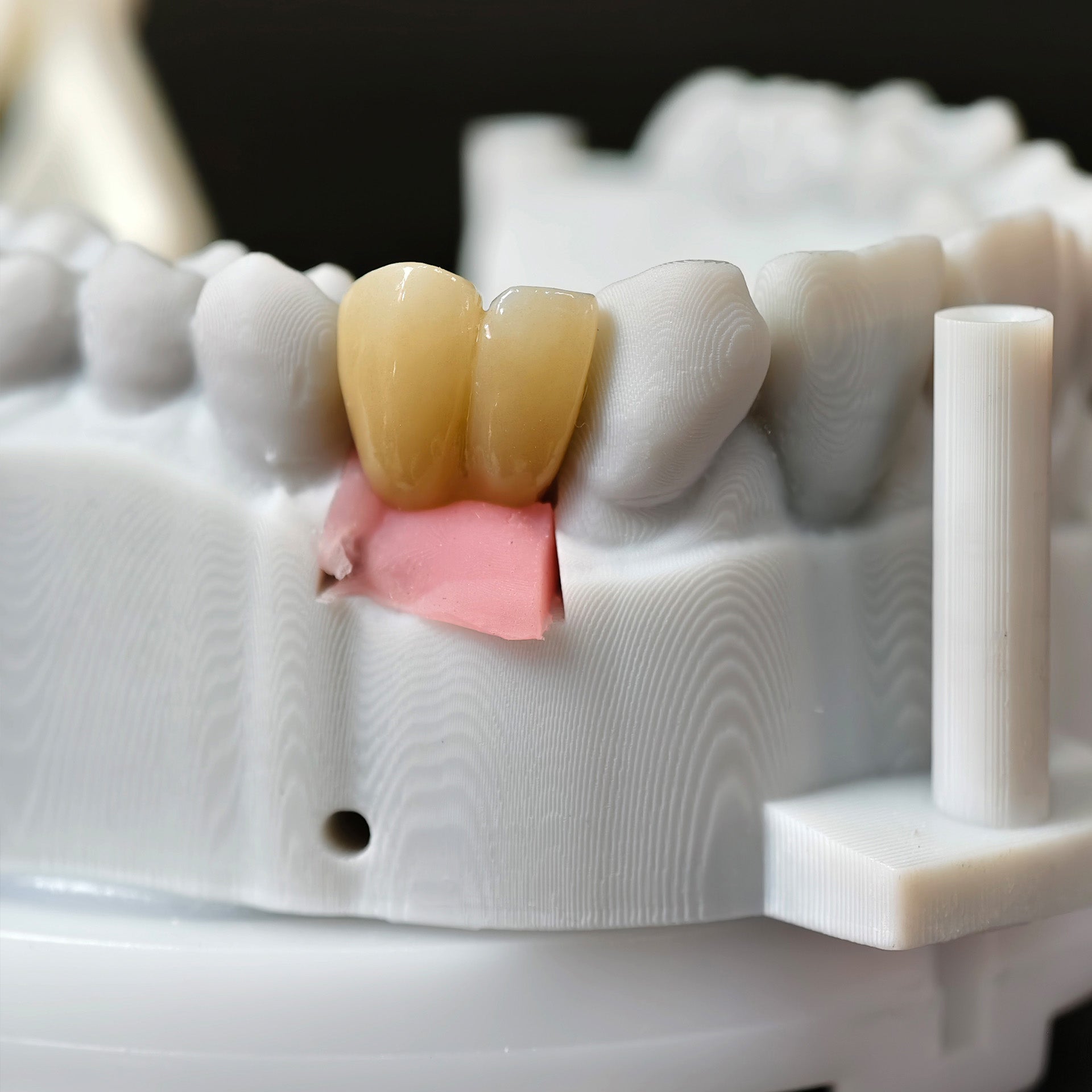 Zirconia Implant Crown With Gold Plating