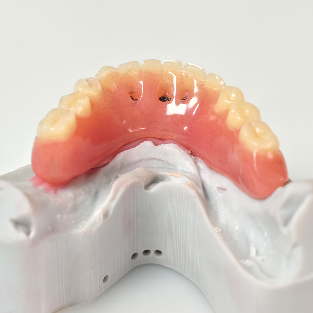Acrylic Denture With Ti-Bar And Screw Retained